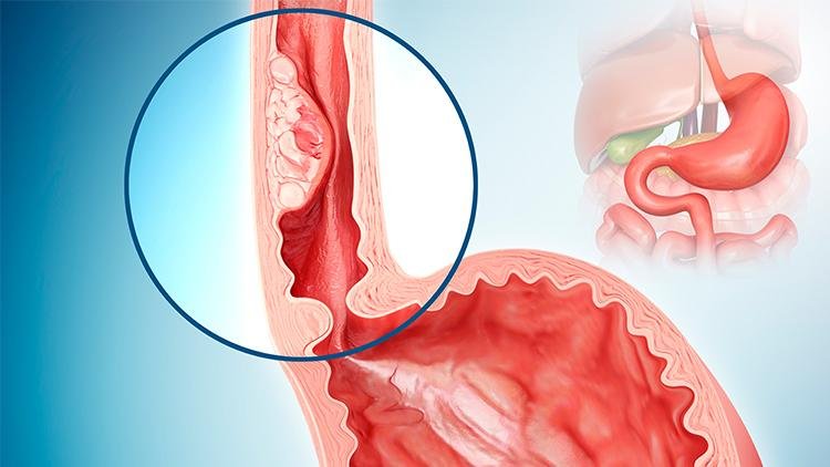 speiseröhrenkrebs alter