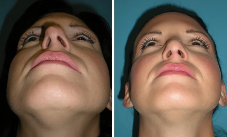 schiefe nasenscheidewand